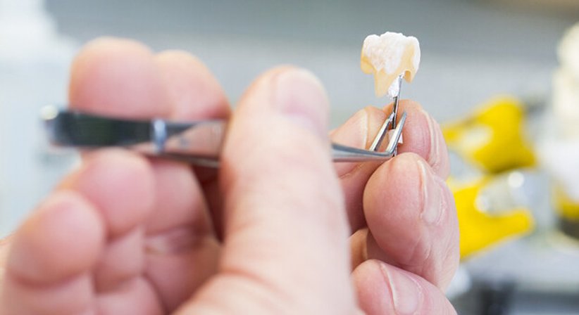 Inlays / Onlays - DDr. Ronald Ringl - Zahnarzt Wien 1030