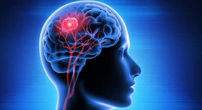 Hypophysenadenom (Gehirntumor)