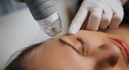 Radiofrequenz-Needling mit DoubleTite oder Potenza