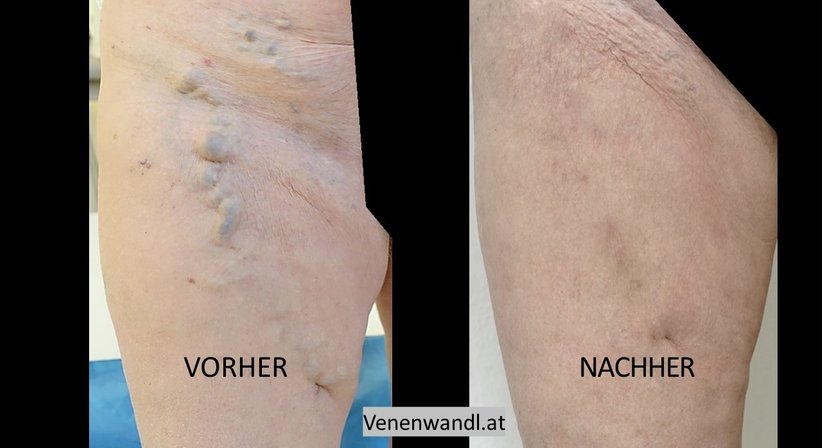 Spezielle Behandlung von Venenrezidiven  - Dr. Ernst Wandl - Radiologe Linz 4020