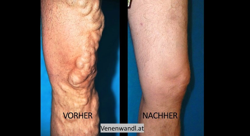 Microschaumbehandlung von Krampfadern - Dr. Ernst Wandl - Radiologe Linz 4020