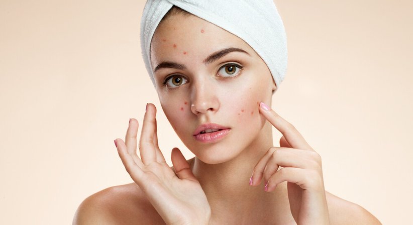 Akne/Rosacea - Dr. Ligia Teban-Bedenicki - Hautärztin Wien 1060