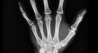 ACP-THERAPIE (autologes conditioniertes Plasma)