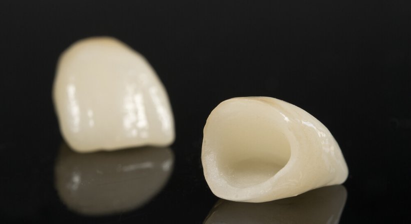 Zahnkronen und Zahnbrücken - Dr. med. dent. Roman Lindenberger - Zahnarzt Wien 1010