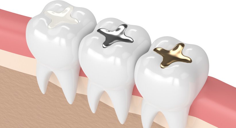 Kompositfüllungen - Dr. med. dent. Roman Lindenberger - Zahnarzt Wien 1010