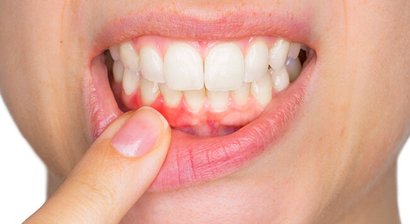 Parodontalbehandlung / Parochirurgie