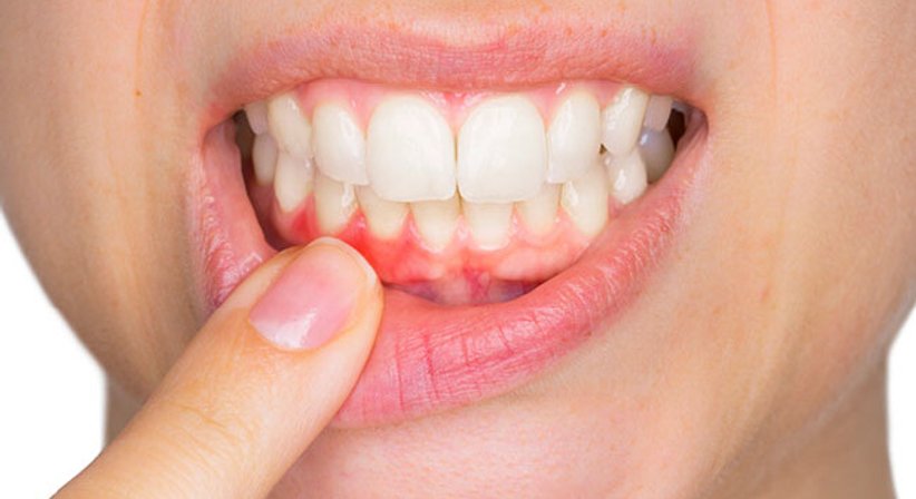 Parodontalbehandlung / Parochirurgie - DDr. Stefanie Weber - Zahnärztin Wien 1010