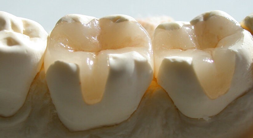 Inlays - DDr. Stefanie Weber - Zahnärztin Wien 1010