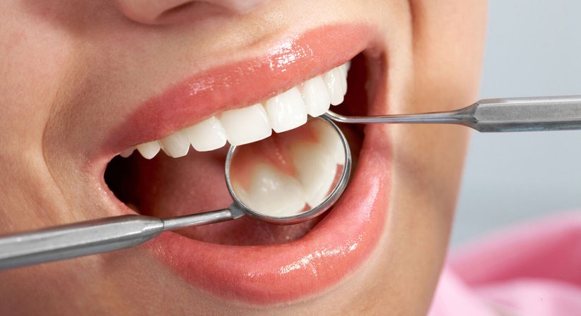 Kompositfüllungen - DDr. Stefanie Weber - Zahnärztin Wien 1010