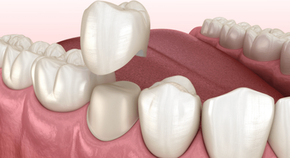 Kronen- und Brückenversorgung