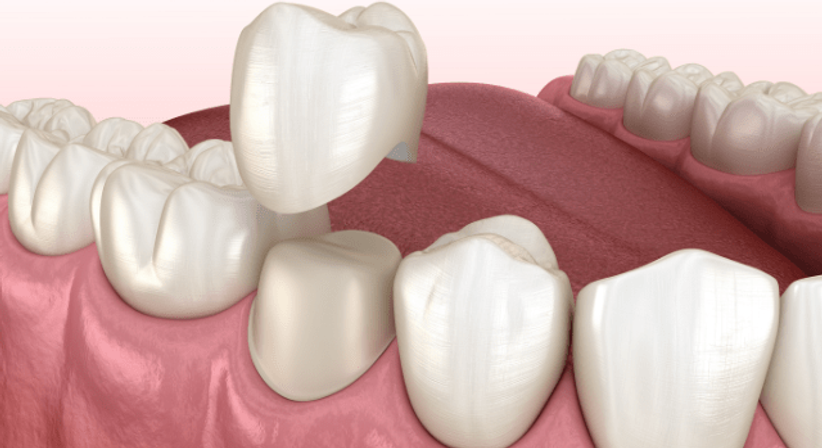 Kronen- und Brückenversorgung - DDr. Stefanie Weber - Zahnärztin Wien 1010