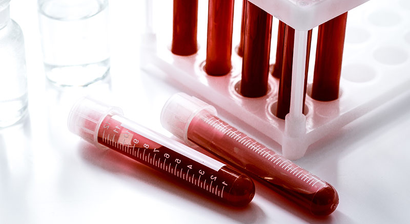 Eigenblutbehandlung (PRF-Therapie)