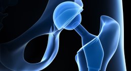 Coxarthrose -