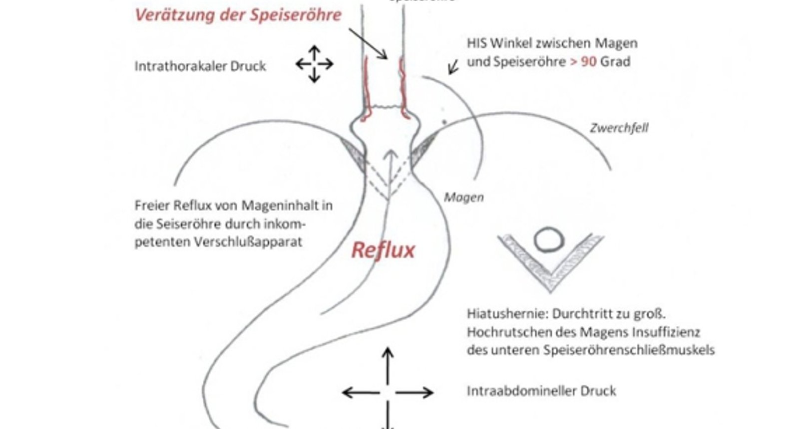 OA Dr. Thomas Winkler - Reflux - Diagnostik und Therapie ...