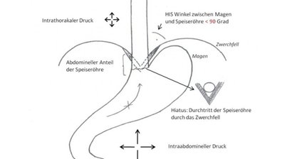 Reflux - Diagnostik und Therapie