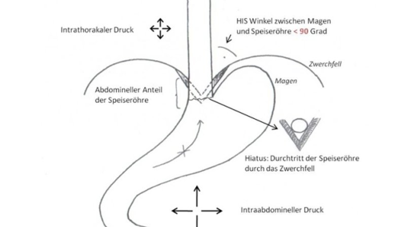 Reflux - Diagnostik und Therapie - OA Dr. Thomas Winkler - Allgemeinchirurg/Viszeralchirurg Wien 1010