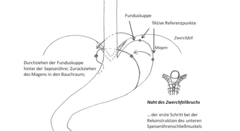Reflux - Diagnostik und Therapie - OA Dr. Thomas Winkler - Allgemeinchirurg/Viszeralchirurg Wien 1010