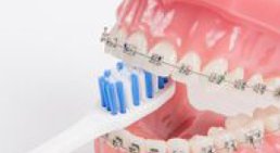 Festsitzende Zahnspange (selbstligierende Brackets) -