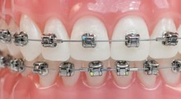 Selbstligierende Brackets -