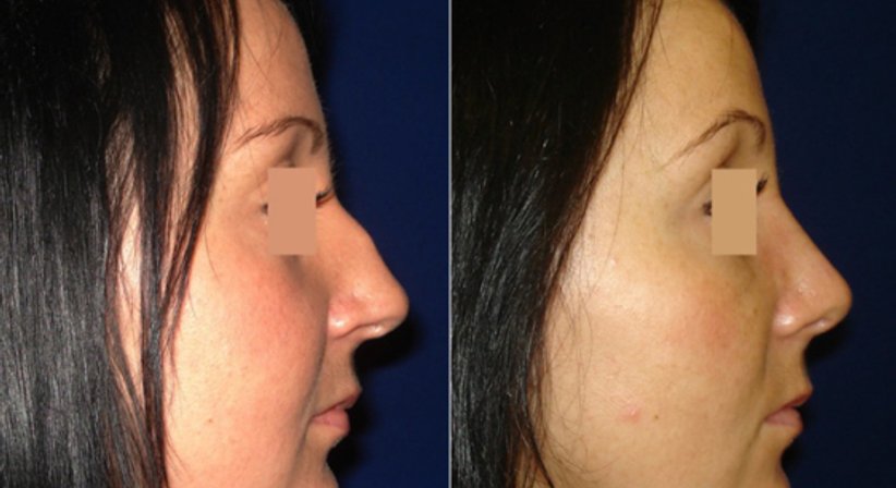 Nasenkorrektur - Dr. Peter Durnig - Plastischer Chirurg Klagenfurt 9020