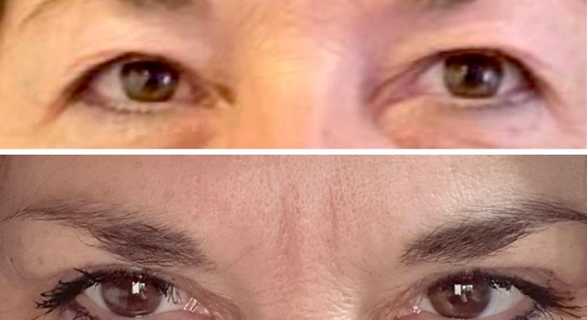 Lidstraffung - Dr. med. univ. Paul Pointinger - Plastischer Chirurg Wien 1190