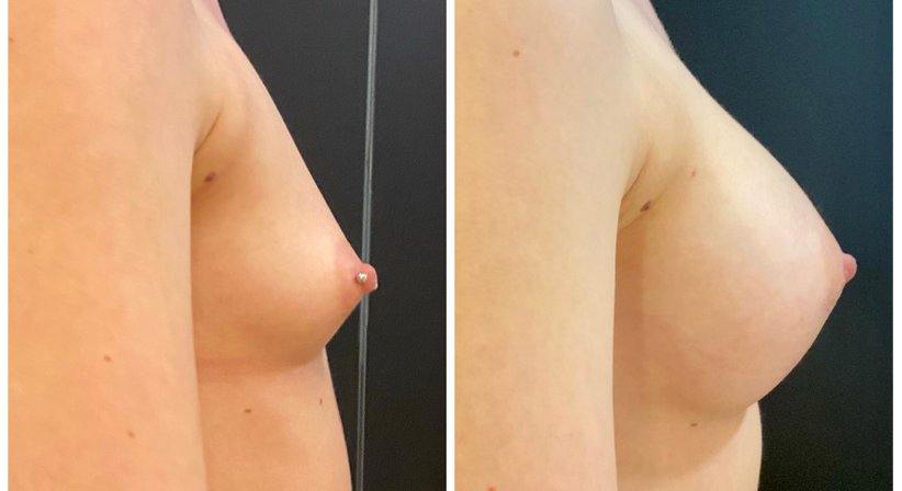 Brustvergrößerung - Dr. med. univ. Paul Pointinger - Plastischer Chirurg Wien 1190