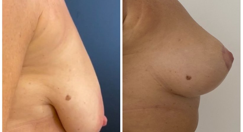 Bruststraffung - Dr. med. univ. Paul Pointinger - Plastischer Chirurg Wien 1190