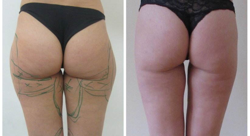 Fettabsaugung - Dr. med. univ. Paul Pointinger - Plastischer Chirurg Wien 1190