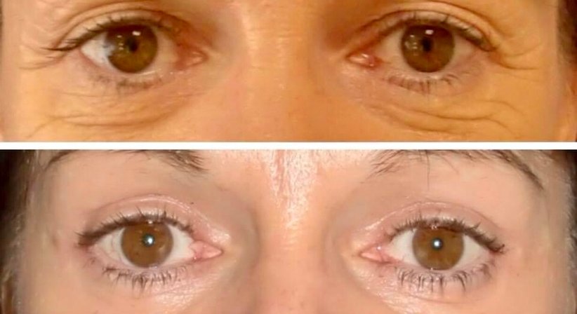 Lidstraffung - Dr. med. univ. Paul Pointinger - Plastischer Chirurg Wien 1190