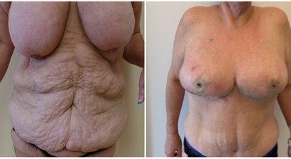 Bauchdeckenstraffungen nach Avelar