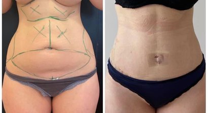 Bauchdeckenstraffung in modifizierter Avelartechnik