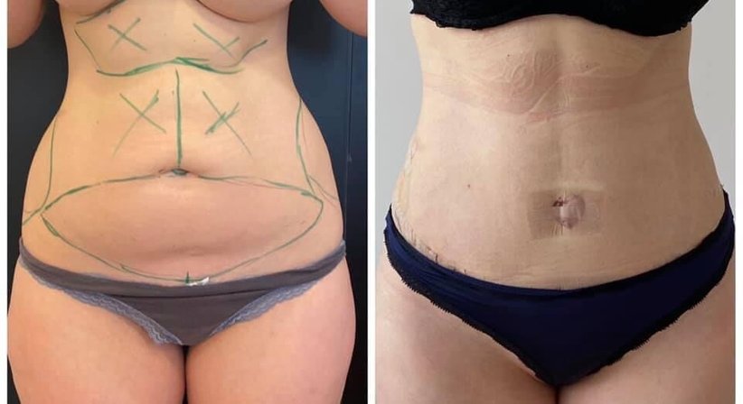 Bauchdeckenstraffung in modifizierter Avelartechnik - Dr. med. univ. Paul Pointinger - Plastischer Chirurg Wien 1190