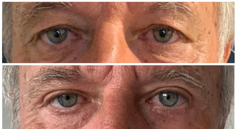 Lidstraffung - Dr. med. univ. Paul Pointinger - Plastischer Chirurg Wien 1190