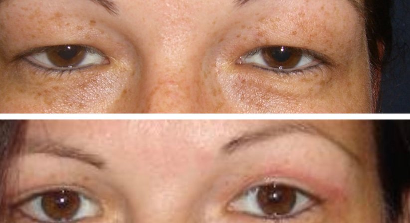 Lidstraffung - Dr. med. univ. Paul Pointinger - Plastischer Chirurg Wien 1190