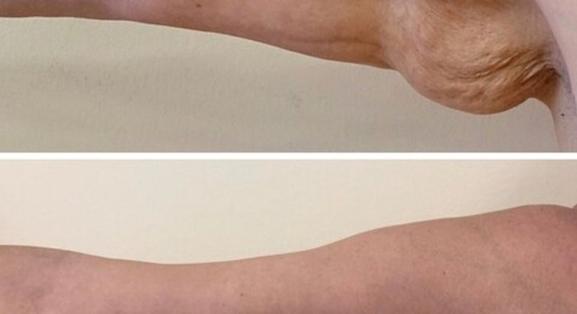 Oberarmstraffung - Dr. med. univ. Paul Pointinger - Plastischer Chirurg Wien 1190