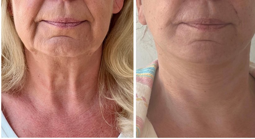 Facelift - Dr. med. univ. Paul Pointinger - Plastischer Chirurg Wien 1190