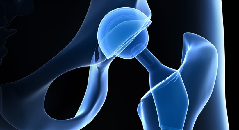Hüftgelenksendoprothese - OA Dr. Christian-Thomas Radda - Orthopäde Hollabrunn 2020
