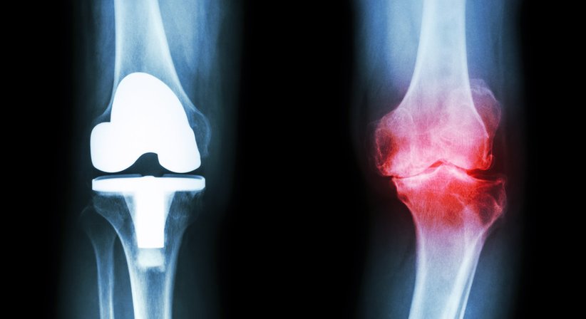 Künstliches Kniegelenk (Knieprothese) - OA Dr. Christian-Thomas Radda - Orthopäde Hollabrunn 2020