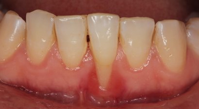 Parodontalchirurgische Eingriffe