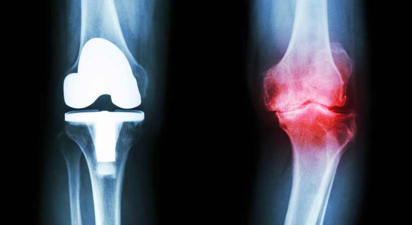 Künstliches Kniegelenk (Knieprothese) - OA Dr. Christian-Thomas Radda - Orthopäde Wien 1190