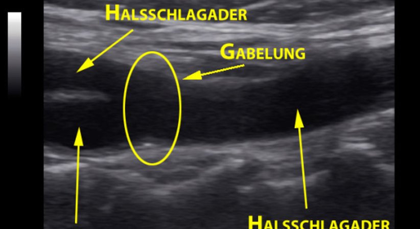 Schlaganfall / Carotisduplex - Dr. Ilyas Kozanli - Internist Wien 1190