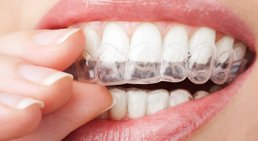 Unsichtbare Zahnspange (Aligner) -