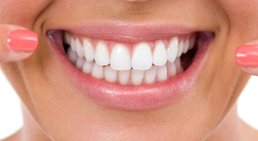 Veneers -
