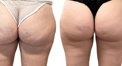 Eigenfett - Butt Lifting, Brustvergrößerung, Gesicht