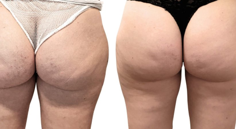 Eigenfett - Butt Lifting, Brustvergrößerung, Gesicht - Dr. Benjamin Gehl, HCM - Plastischer Chirurg Wien 1190