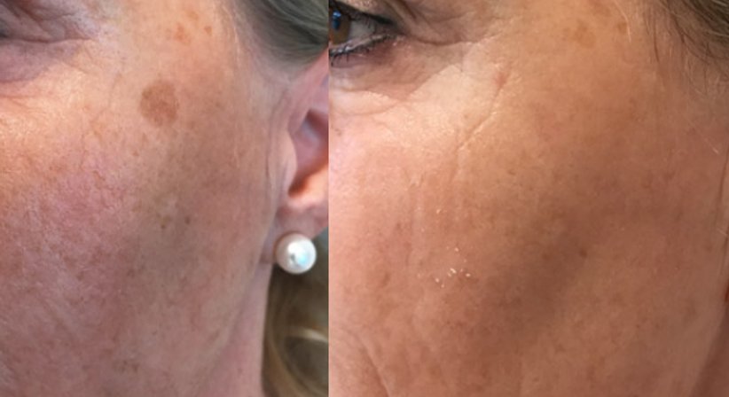 Laserbehandlungen - Dr. Benjamin Gehl, HCM - Plastischer Chirurg Wien 1190