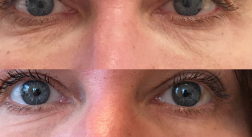 Laserbehandlungen - Dr. Benjamin Gehl, HCM - Plastischer Chirurg Wien 1190