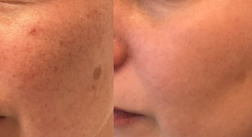Laserbehandlungen - Dr. Benjamin Gehl, HCM - Plastischer Chirurg Wien 1190