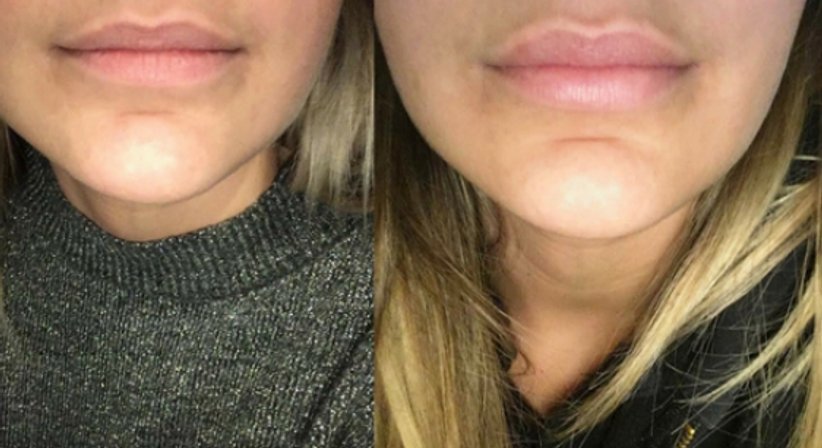 Lip Flip - Dr. Benjamin Gehl, HCM - Plastischer Chirurg Wien 1190