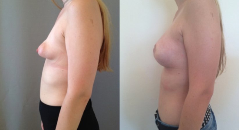Tubuläre Brust - Dr. Benjamin Gehl, HCM - Plastischer Chirurg Wien 1190